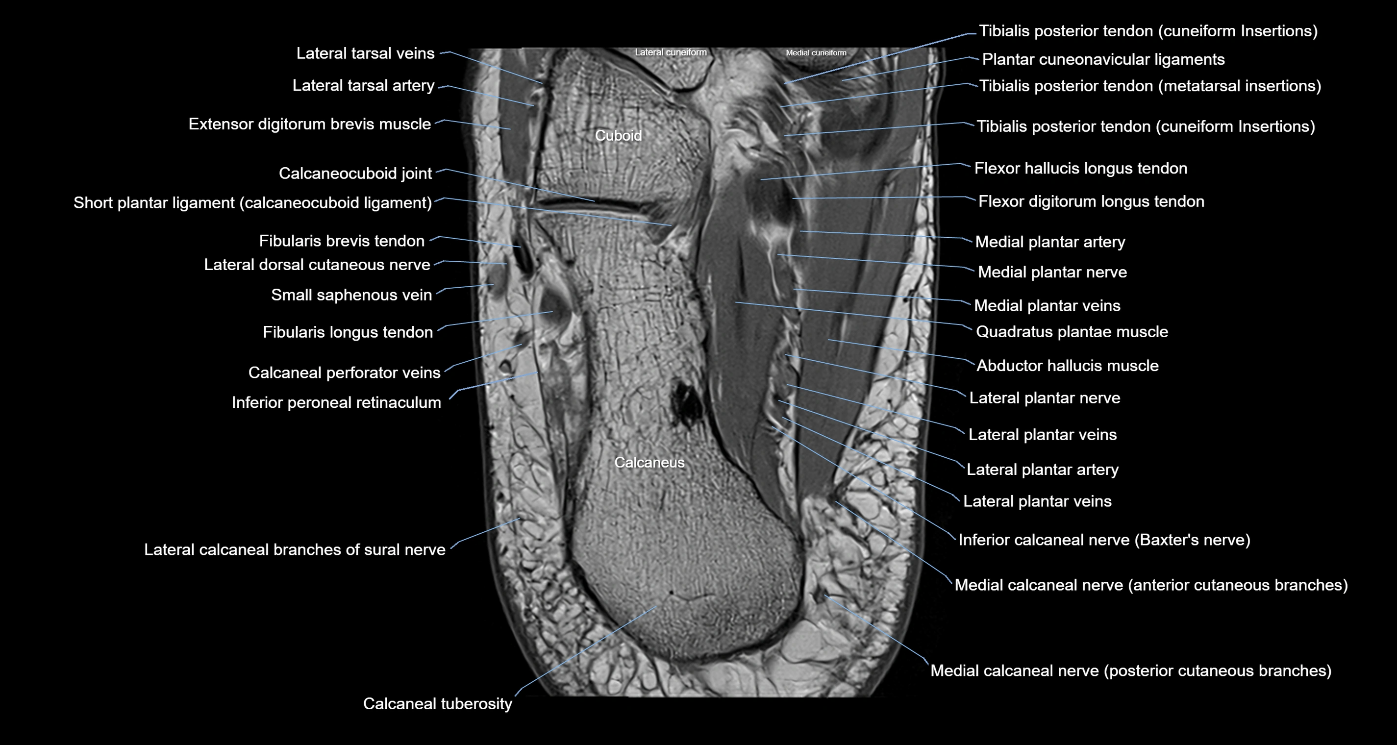 Ankle axial anatomy 3T MRI images -img-10001-00033.webp